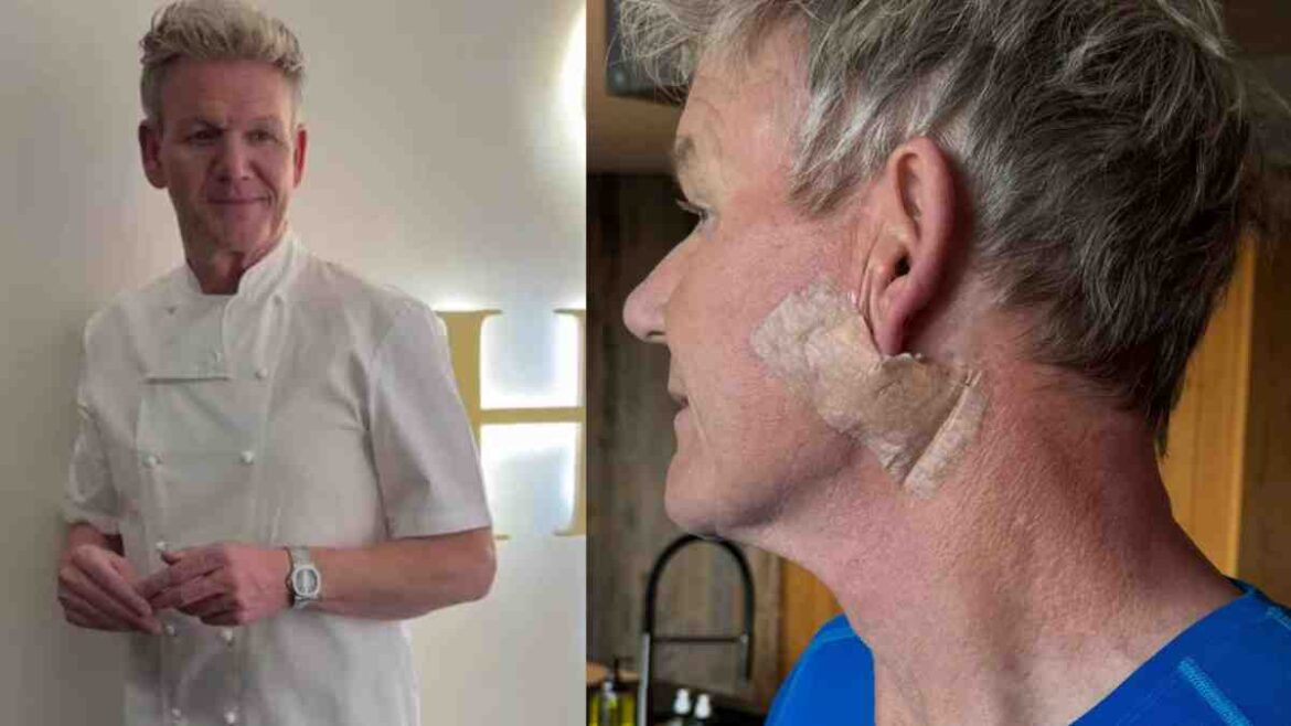 Gordon Ramsay Reveals Skin Cancer Surgery, Urges Fans To Wear Sunscreen | Glamsham.com